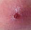 picture of a skin boil