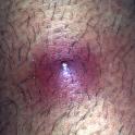 infected hair follicle or skin boil
